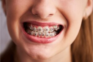 aparat-dentar-brackets-roz-ismed