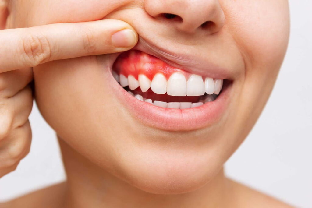 Gingiile care sângerează nu sunt normale. Și totuși, jumătate din adulți le ignoră