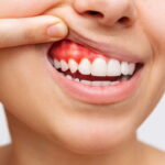 Gingiile care sângerează nu sunt normale. Și totuși, jumătate din adulți le ignoră